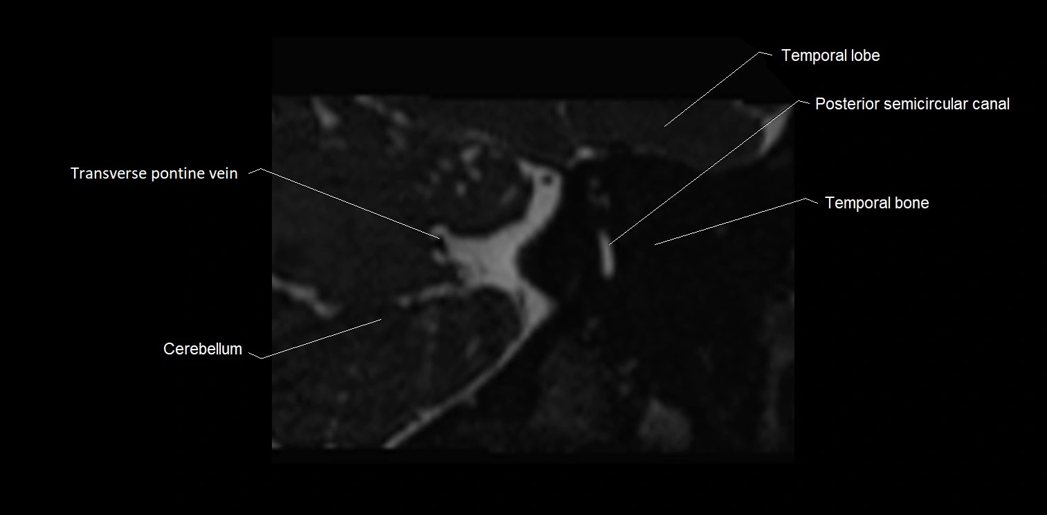 MRI Internal auditory meatus (IAM) coronal cross sectional labelled anatomy image 33.webp